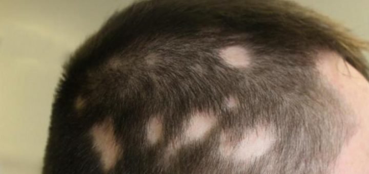 гнездовая алопеция