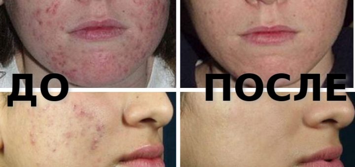до и после карбонового пилинга