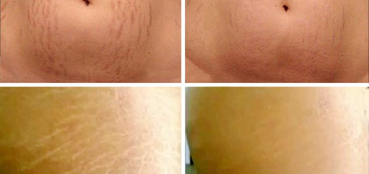 удаление растяжек лазером до и после