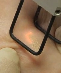 Удаление растяжек лазером