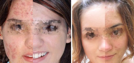 срединный пилинг