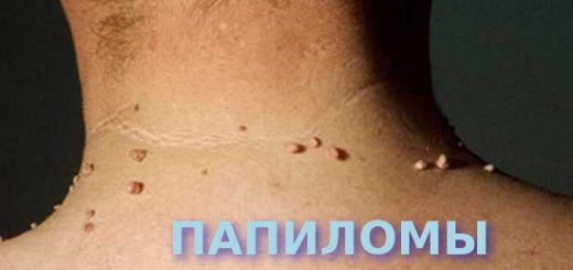 папиломы