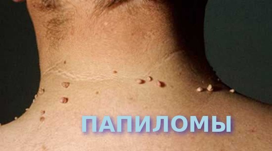 папиломы