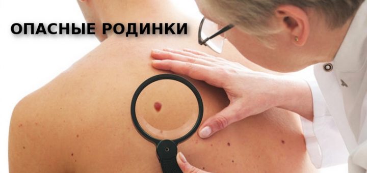 опасные родинки