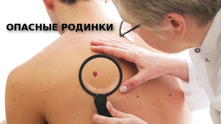опасные родинки