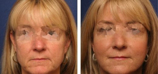 Векторный лифтинг