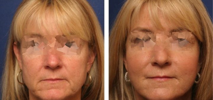 Векторный лифтинг