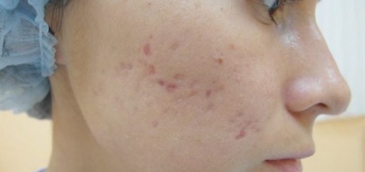 Лечение акне