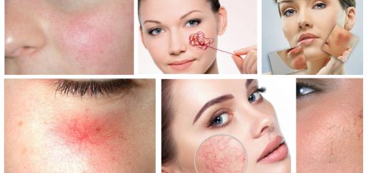 купероз на лице