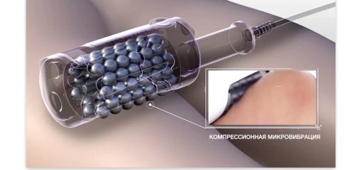 Эндосфера Терапия против целлюлита