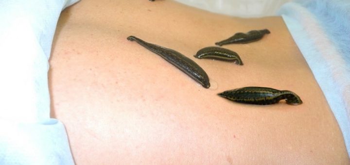 гирудотерапия для похудения