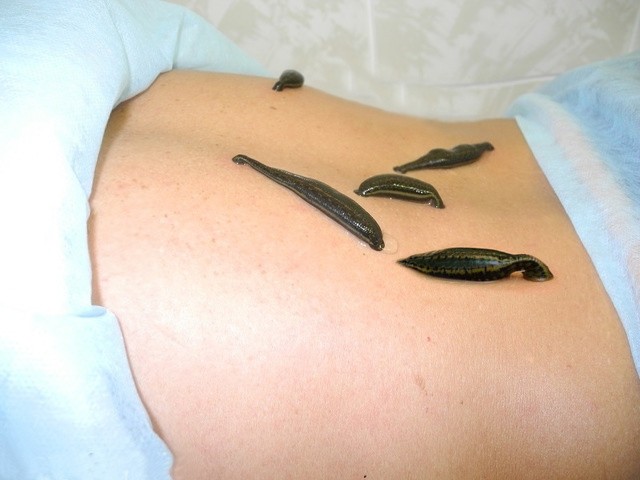 гирудотерапия для похудения