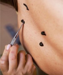 Гирудотерапия в косметологии