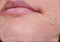 после АБР пилинга