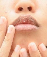 Сухость губ