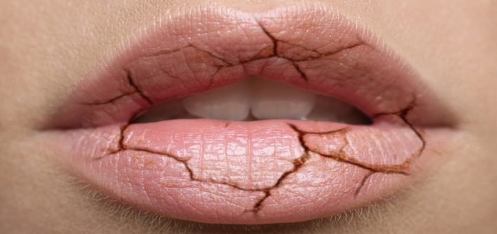сохнут губы