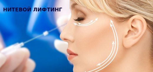 Нитевой хирургический лифтинг