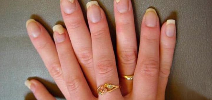 грибок ногтей на руках