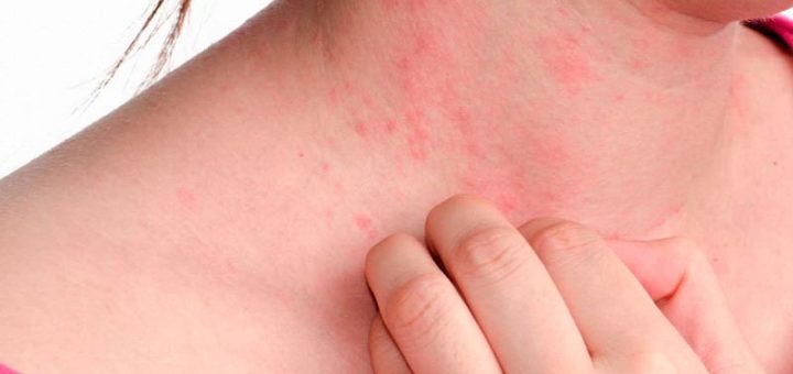 Крапивница, как определить и что предпринять