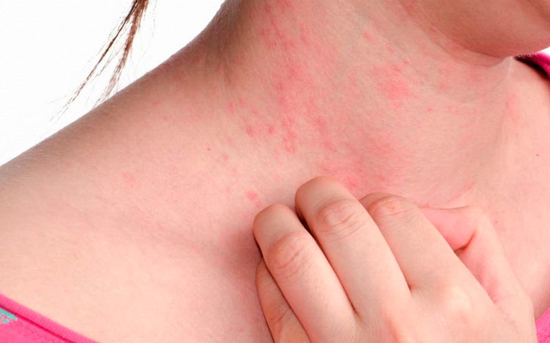 Крапивница, как определить и что предпринять