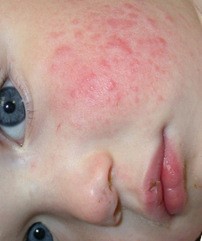 крапивница у детей