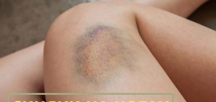 СИНЯКИ БЕЗ ПРИЧИНЫ