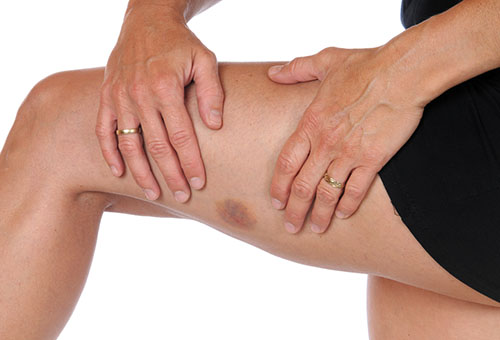 Синяк на бедре