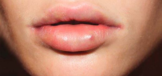 уплотнения на губах от биополимера