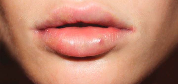 уплотнения на губах от биополимера
