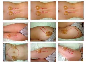 баночный массаж от целлюлита