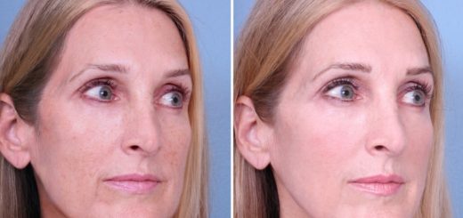 Термаж до и после