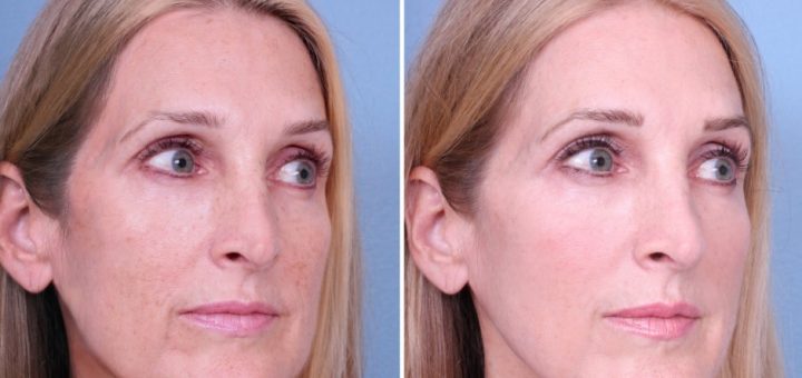 Термаж до и после