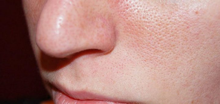 Расширенные поры лица