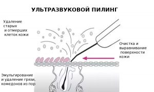 Ультразвуковое скрабирование