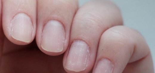слоящиеся ногти