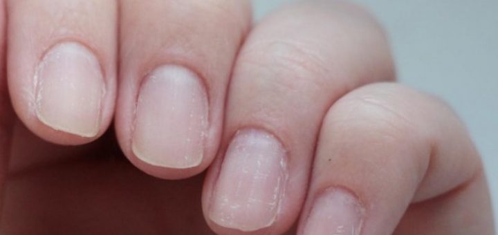 слоящиеся ногти