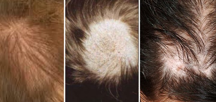 Женское облысение