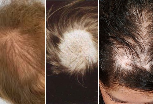 Женское облысение