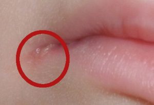 Заеды в уголках губ