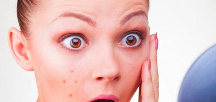 Прыщи в подростковом возрасте