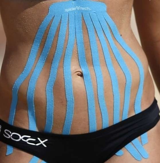 кинезиотейпирование в области живота