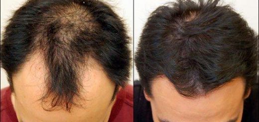 Результаты пересадки волос