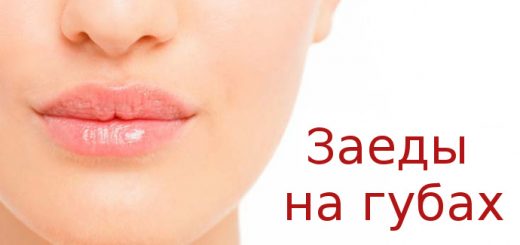 Заеды на губах
