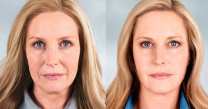 До и после введения филлеров