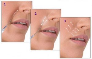 этапы воздействия гиалуроновой кислоты