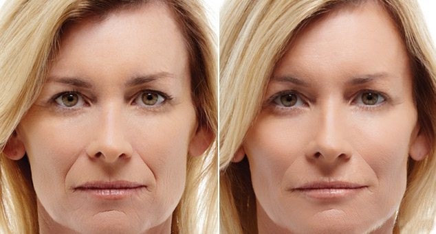 До и после введения филлеров