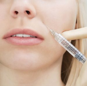 Заполнение носогубных складок филлерами