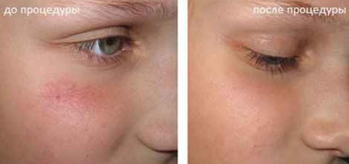 лечение купероза на лице