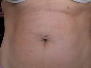 следы от пирсинга на животе