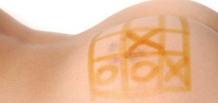 Фурункул на ягодицах